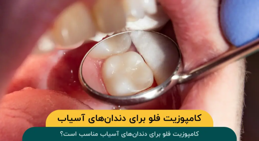 کامپوزیت-فلو-دندان‌-های-آسیاب